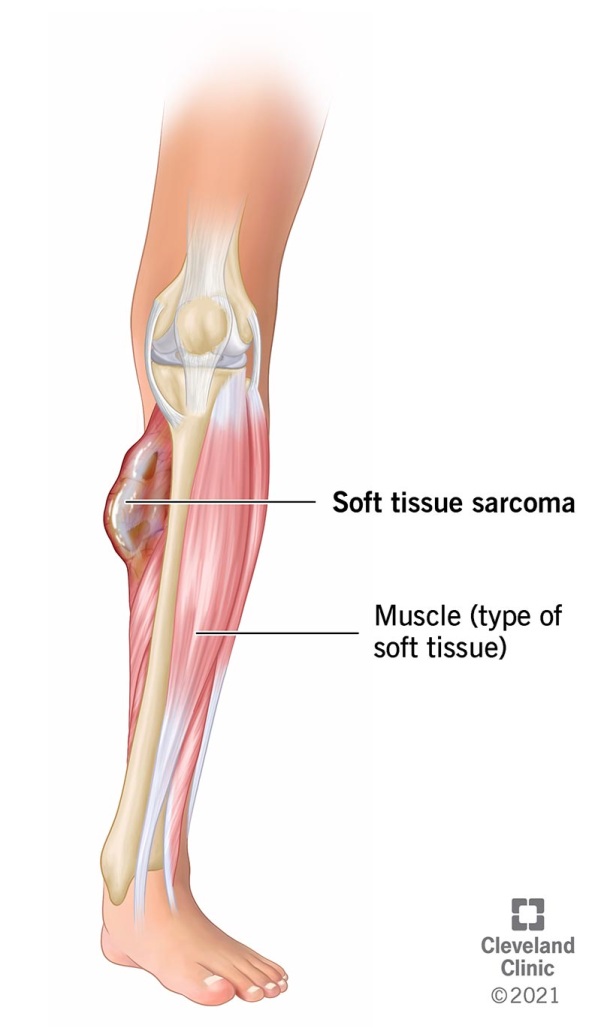Diagram of the bone, muscle, and soft tissue sarcomas